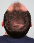 Before Hair Transplant&nbsp;Front
